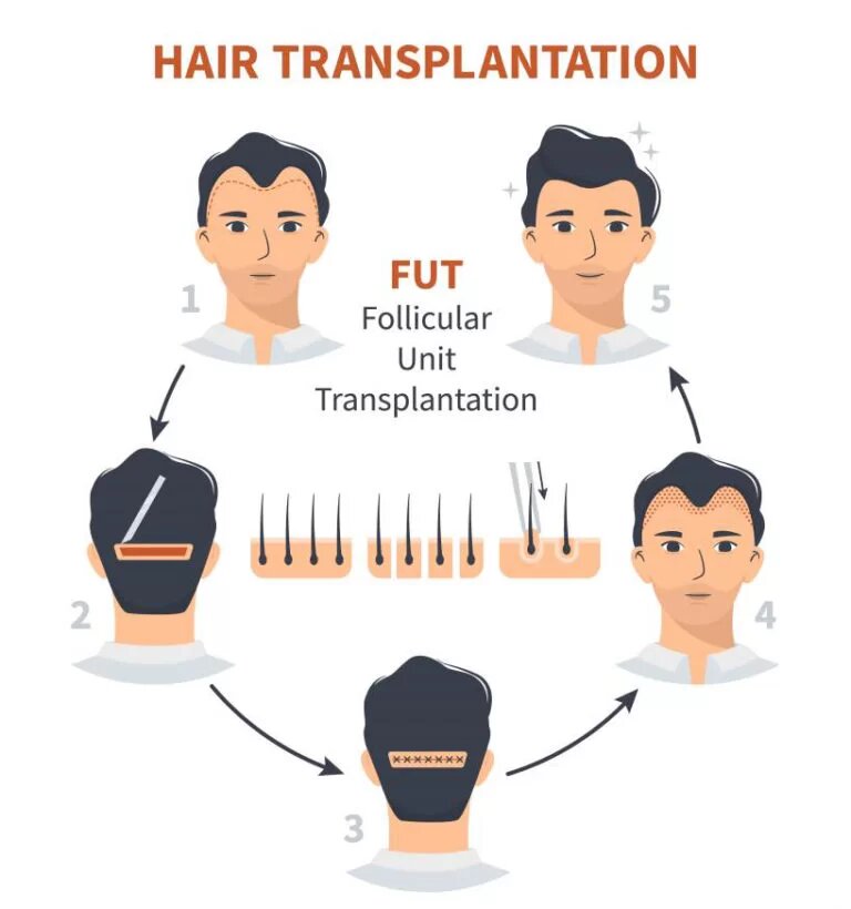 fut hair transplant