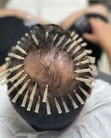 pdo scalp threading treatment