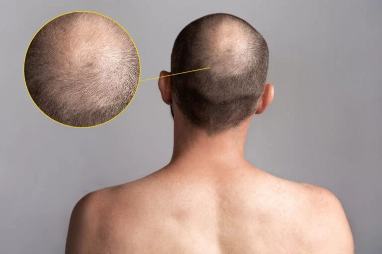 men’s hair loss problems